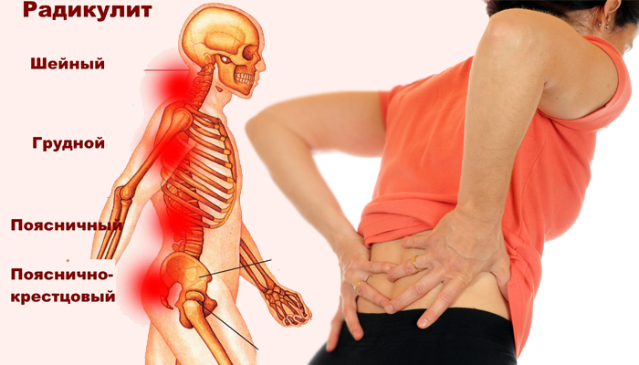 Какой бывает радикулит