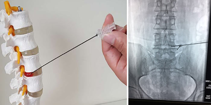 При метастазах в кости болит спина